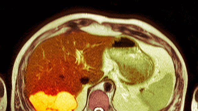 Snímek z poèítaèové tomografie ukazuje metastázující karcinom jater. Tmavé skvrny na játrech jsou nádory. Jde o druhotnou rakovinu jater, kdy se rakovinové buòky šíøí z jiných orgánù, jako je tlusté støevo, žaludek, prsa nebo plíce. 